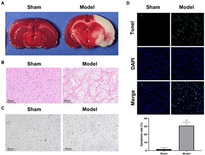 Knockdown of ATF3 suppresses the progression of ischemic stroke through inhibiting ferroptosis